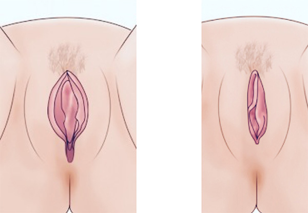 Como se hace un exudado vulvar en casa